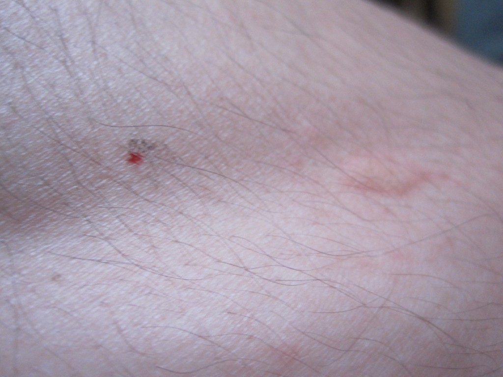 蚊に刺されて膨疹ができた足と残り血