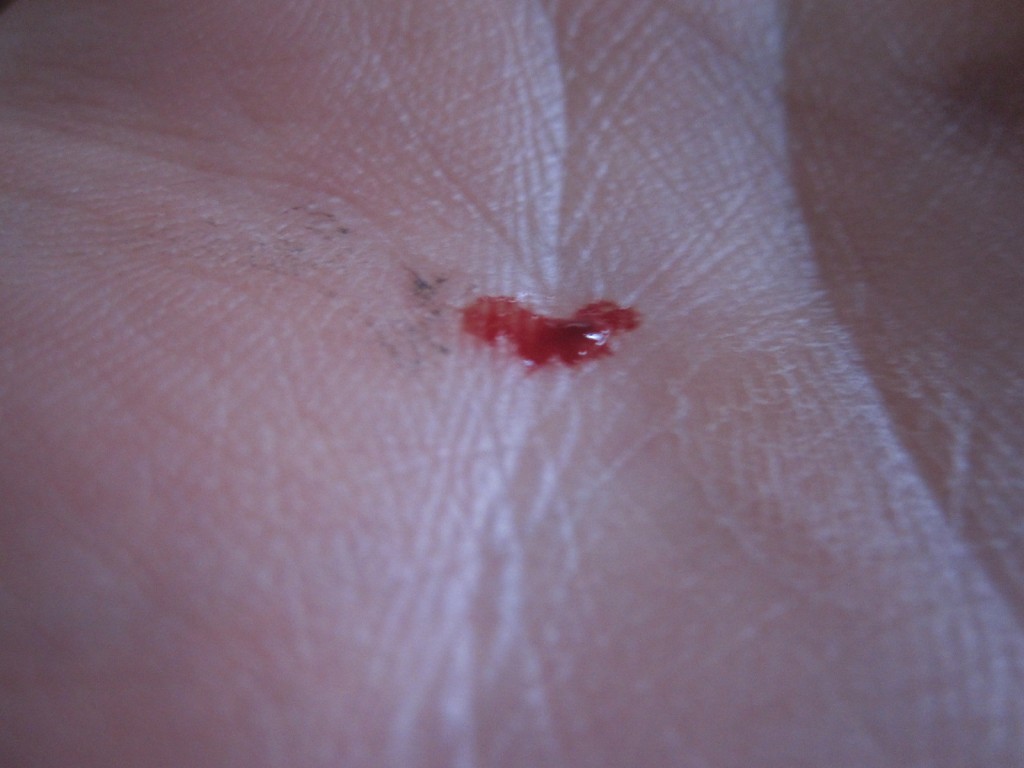 蚊が人間から吸い上げた血液の痕