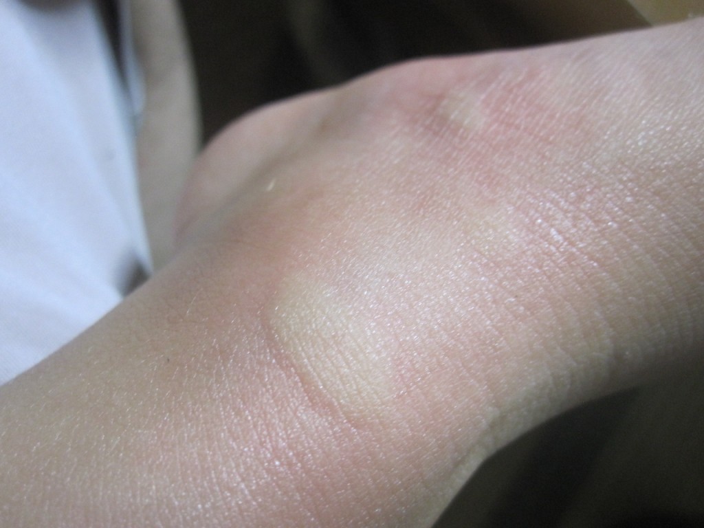 蚊に刺され血を吸われアレルギー反応で膨れた皮膚