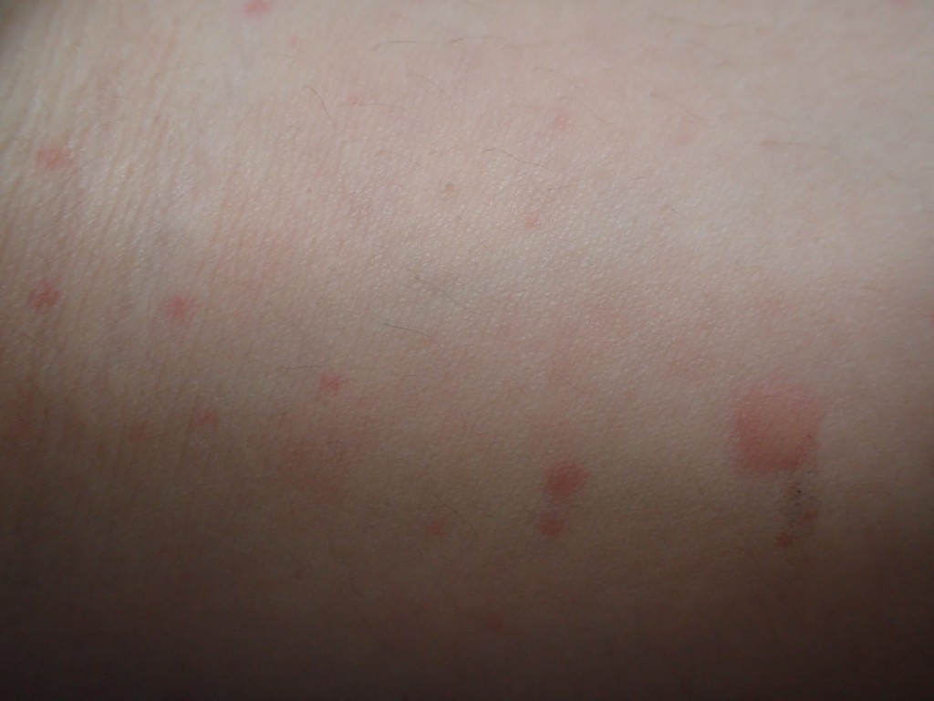 蚊に刺された箇所が徐々に痒くなり赤く膨らみだす