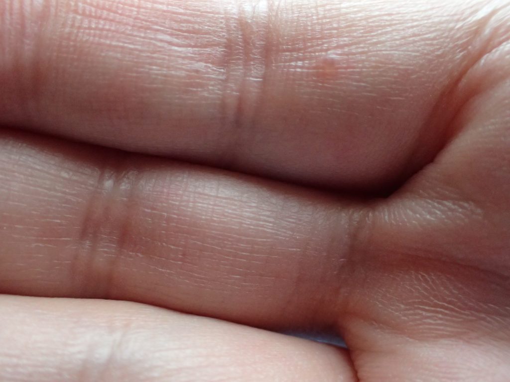 手の指にできた水泡は汗が原因の汗疱（かんぽう）？
